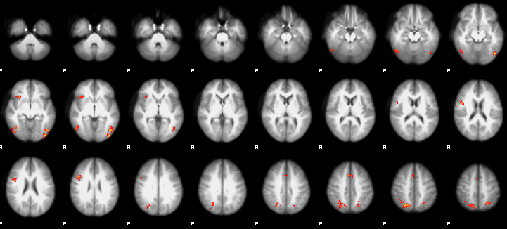 ../_images/3rdLevelAnalysis_FEAT_Output.png